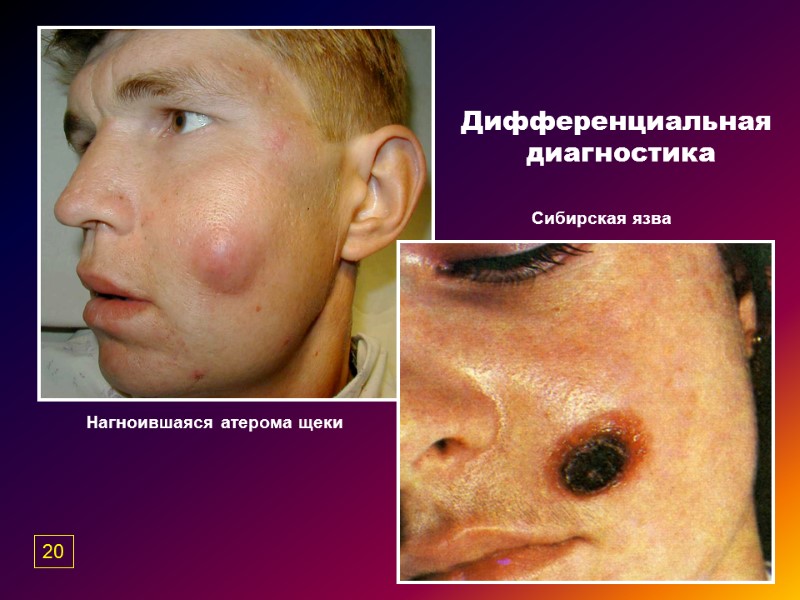 Дифференциальная  диагностика Нагноившаяся атерома щеки Сибирская язва 20